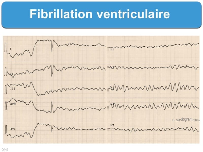 Défibrillation définition et principe Blog du matériel médical