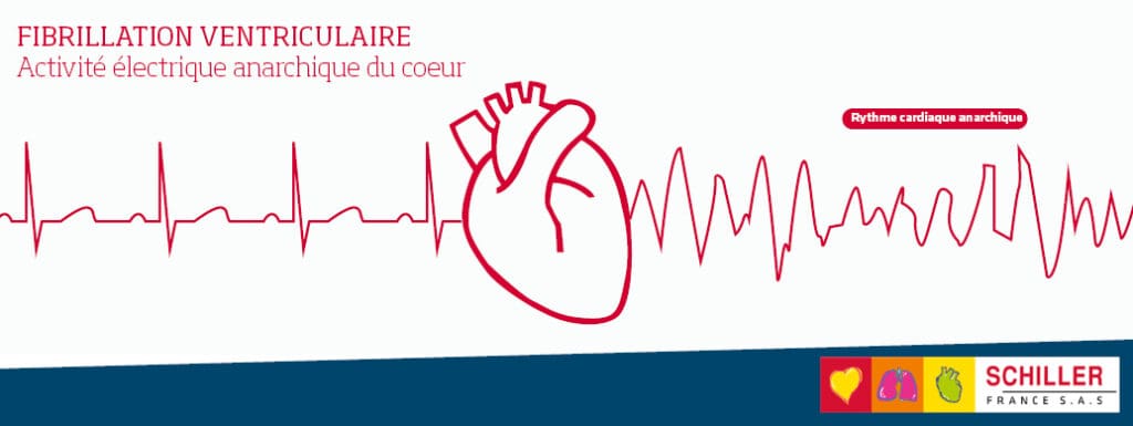 Fibrillation ventriculaire