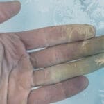 Pourquoi prévenir l’hypothermie est vital ?