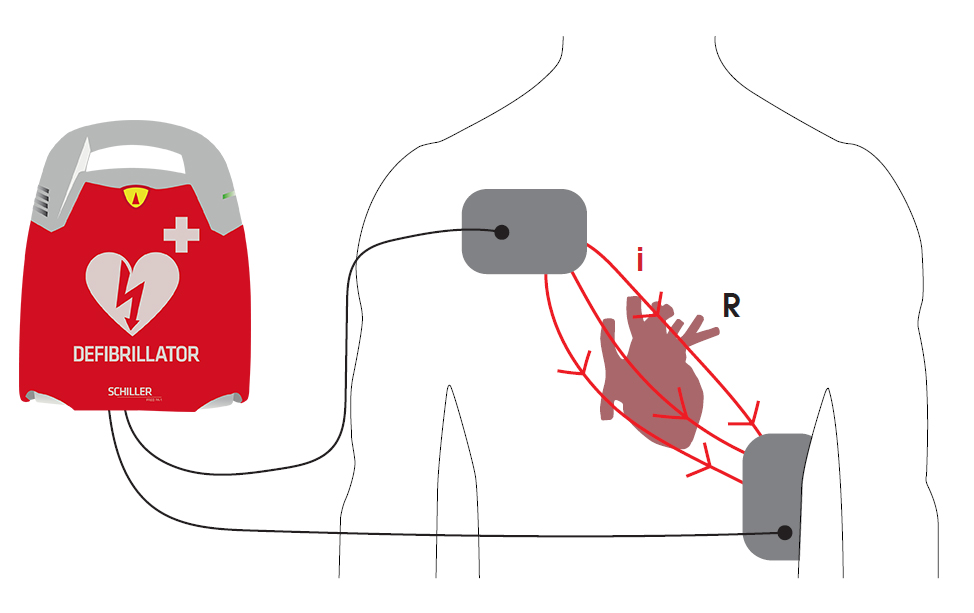 Quand et comment utiliser un défibrillateur cardiaque ?